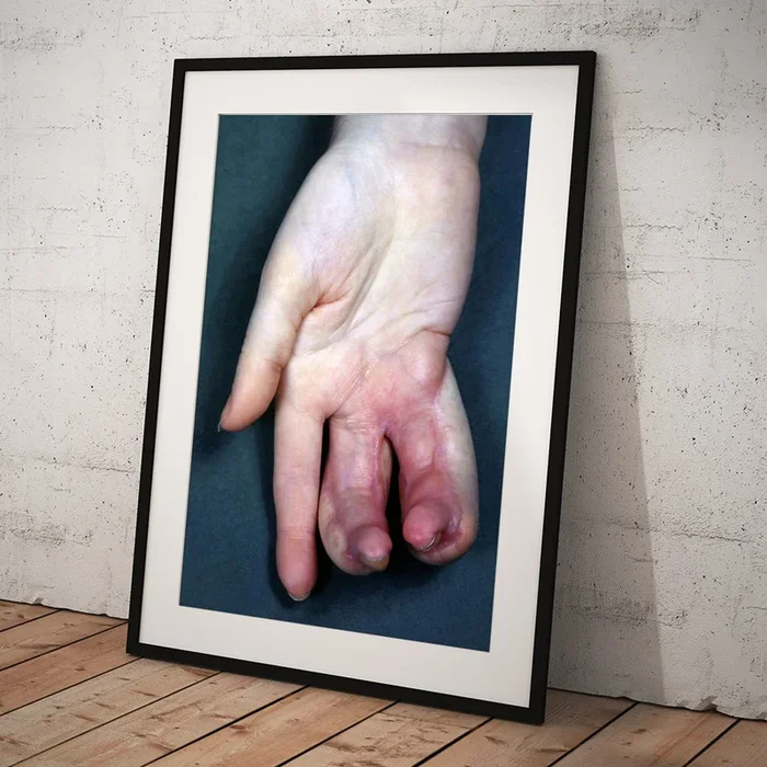 X-ray Burns Art Print